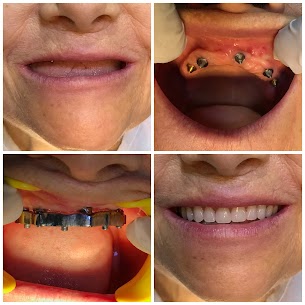 Implant Overdentures
