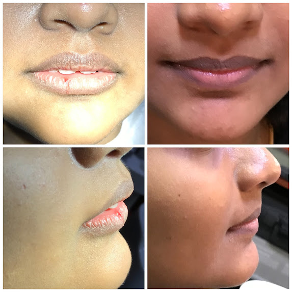 Fast Braces Extraction