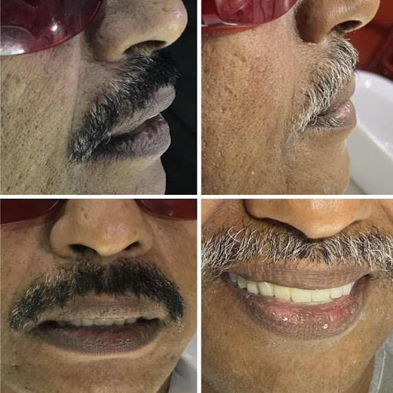 Full Mouth Rehabilitation