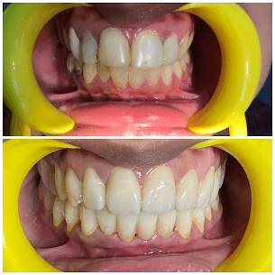 Full Mouth Crowns