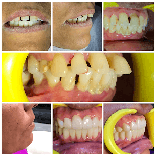Comprehensive Periodontal Treatment