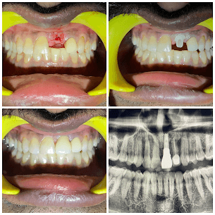 Deep Implant Restoration