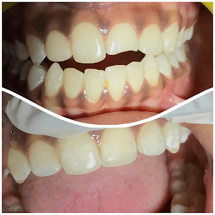 Pediatric Composite Restoration