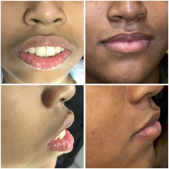 Invisalign Treatment