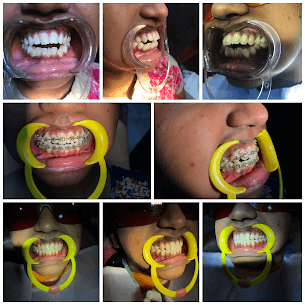 Skeletal Open Bite Treatment