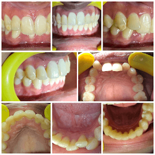 Fast Braces Alignment