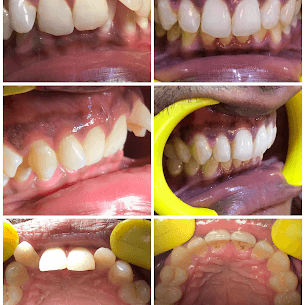 Invisalign Correction