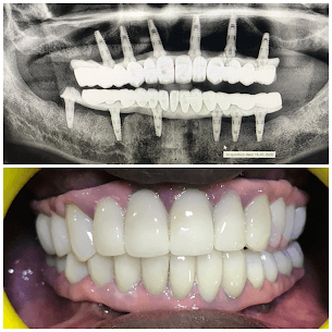 Full Mouth Malo Bridge