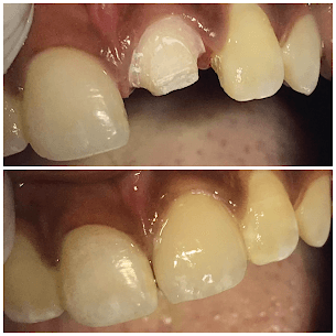 Crown Restoration