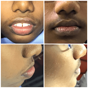 Fast Braces Correction