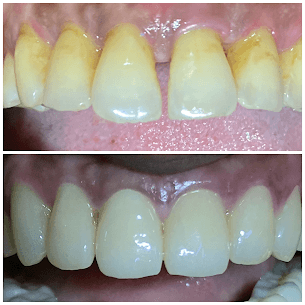 Aesthetic Crown Work