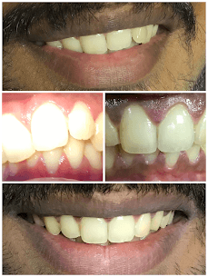 Smile Design with Fast Braces