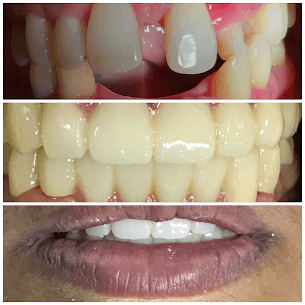 Periodontal Smile Design