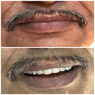 Vertical Dimension Restoration