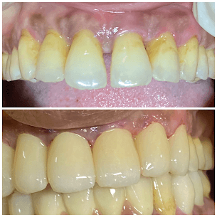 Periodontal Crown Treatment