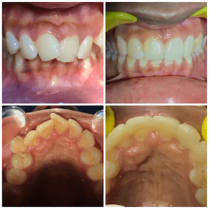 Conservative Invisalign