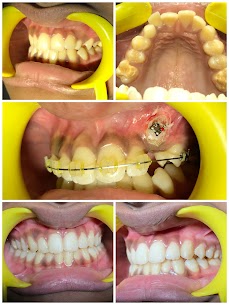 Fast Braces with Surgical Intervention