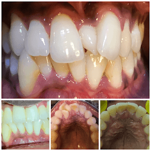 Surgical Orthodontics