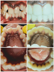 Fast Braces for Crowding