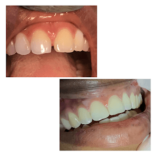 Quick Composite Solution