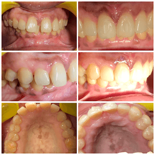 Senior Invisalign
