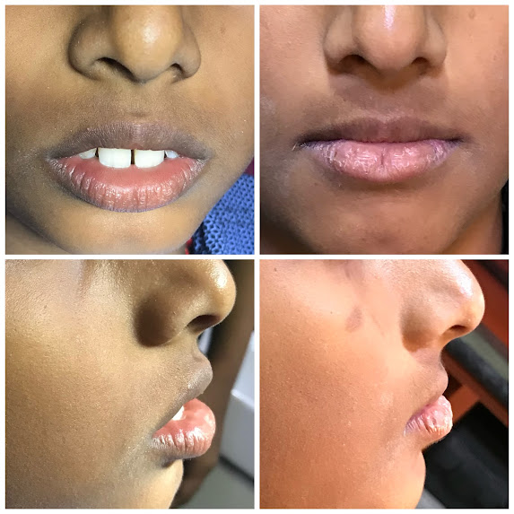 Twin Block Treatment