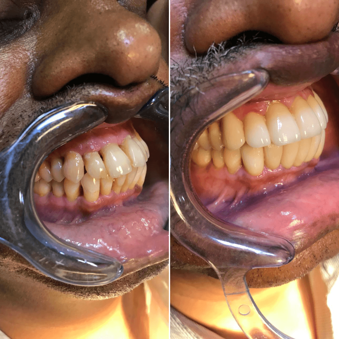 Gum Disease Space Closure