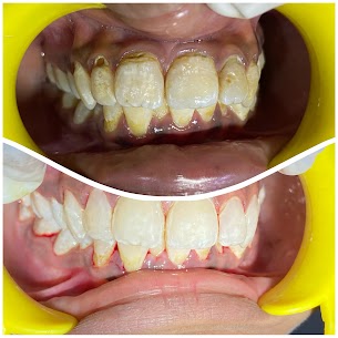 Post-Braces Restoration