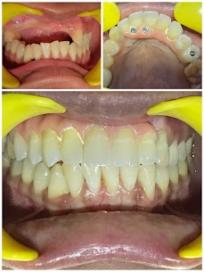 Malo Bridge Implants