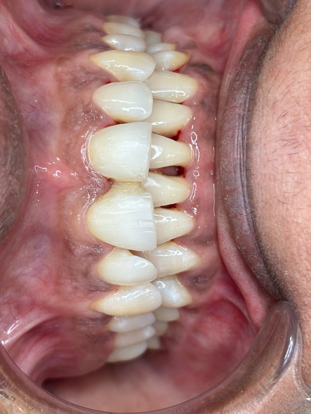 Corrected crown placement with ideal occlusion