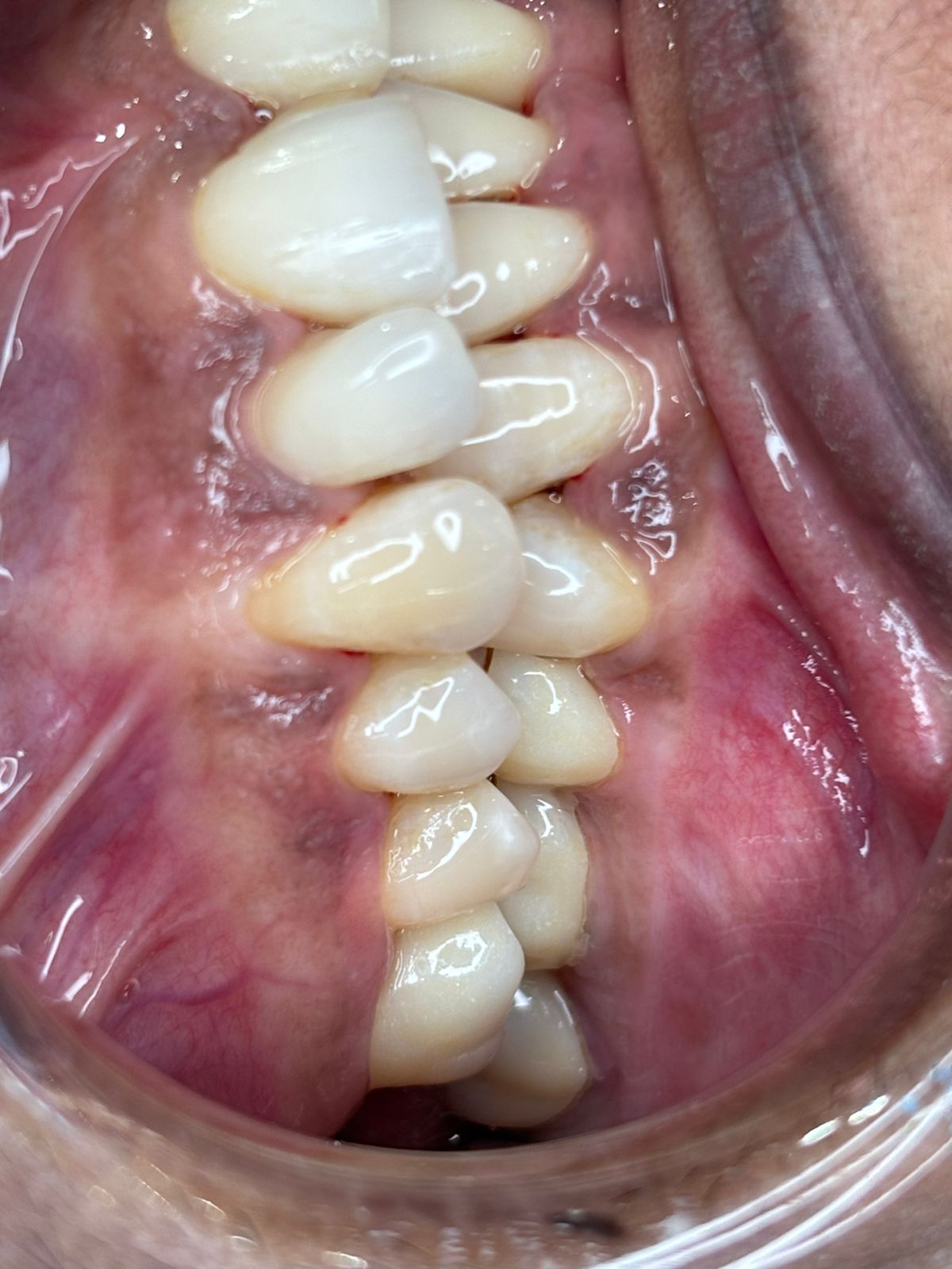 Complete smile transformation with new crowns