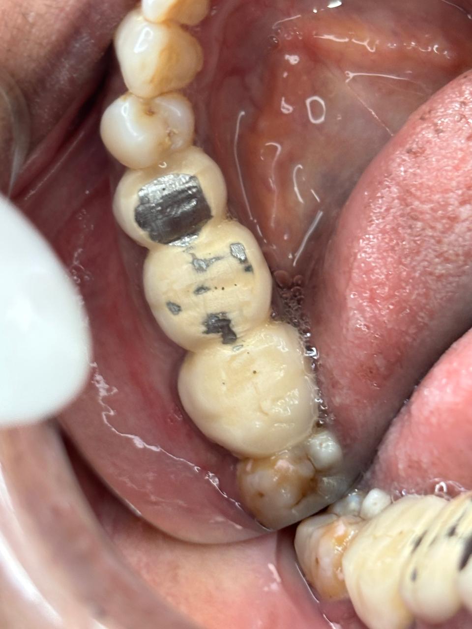 Initial crown misalignment showing improper bite relationship