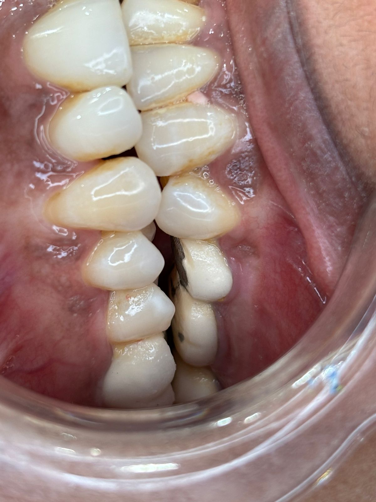 Problematic crown placement affecting occlusion