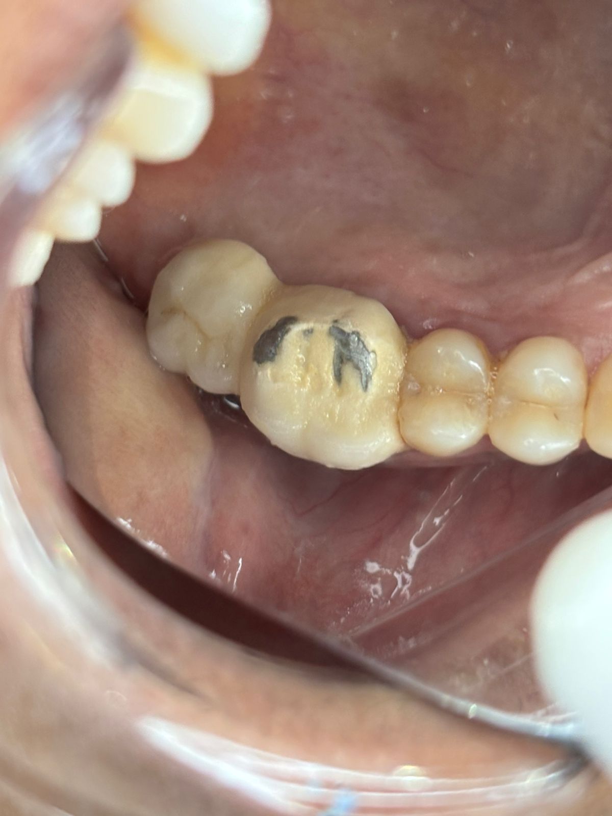 Bite analysis revealing misaligned crown position